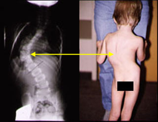 Scoliosis Scoliosis (1).jpg